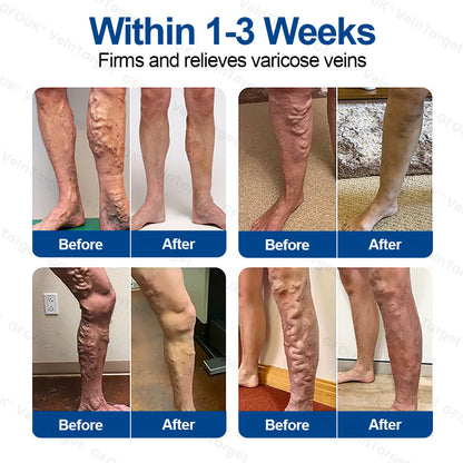 🇺🇸👨‍⚕️✨🌿𝐇𝐞𝐚𝐥𝐫𝐢𝐳𝐞® VeinTarget Microneedle Patch⚡Instant Relief, Long-Term Results