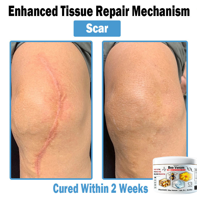 TO𝑫A𝐇OF®🎄🎄 𝑩𝒆𝐞 𝑽𝐞𝒏𝒐𝒎 𝑴𝒖𝒍𝒕𝒊-𝑺𝒚𝒎𝒑𝒕𝒐𝒎 𝑺𝒌𝒊𝒏 𝑻𝒓𝐞𝒂𝒕𝒎𝒆𝒏𝒕 𝑪𝒓𝐞𝒂𝒎 (👨‍⚕𝑵𝑷𝑭 𝑹𝑬𝑪𝑶𝑴𝑴𝑬𝑵𝑫𝑺)